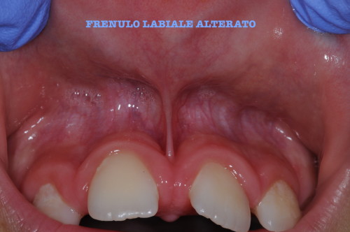 frenulo labiale lungo